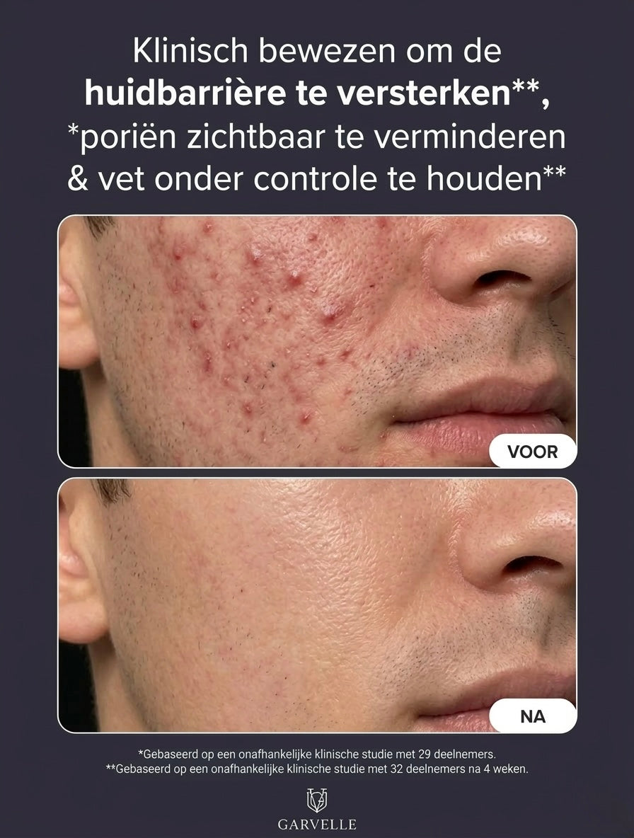 Garvelle Acne Reset Serum (15ml)