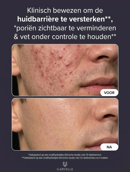Garvelle Acne Reset Serum (15ml)